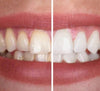 GlowSmile Gel Sbiancante per Denti – Per denti immediatamente bianchi e splendenti