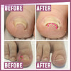 Teennagels Correctie Pleisters