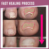 Teennagels Correctie Pleisters