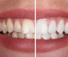 PerfectSmile – Gel Sbiancante per un Sorriso Radioso